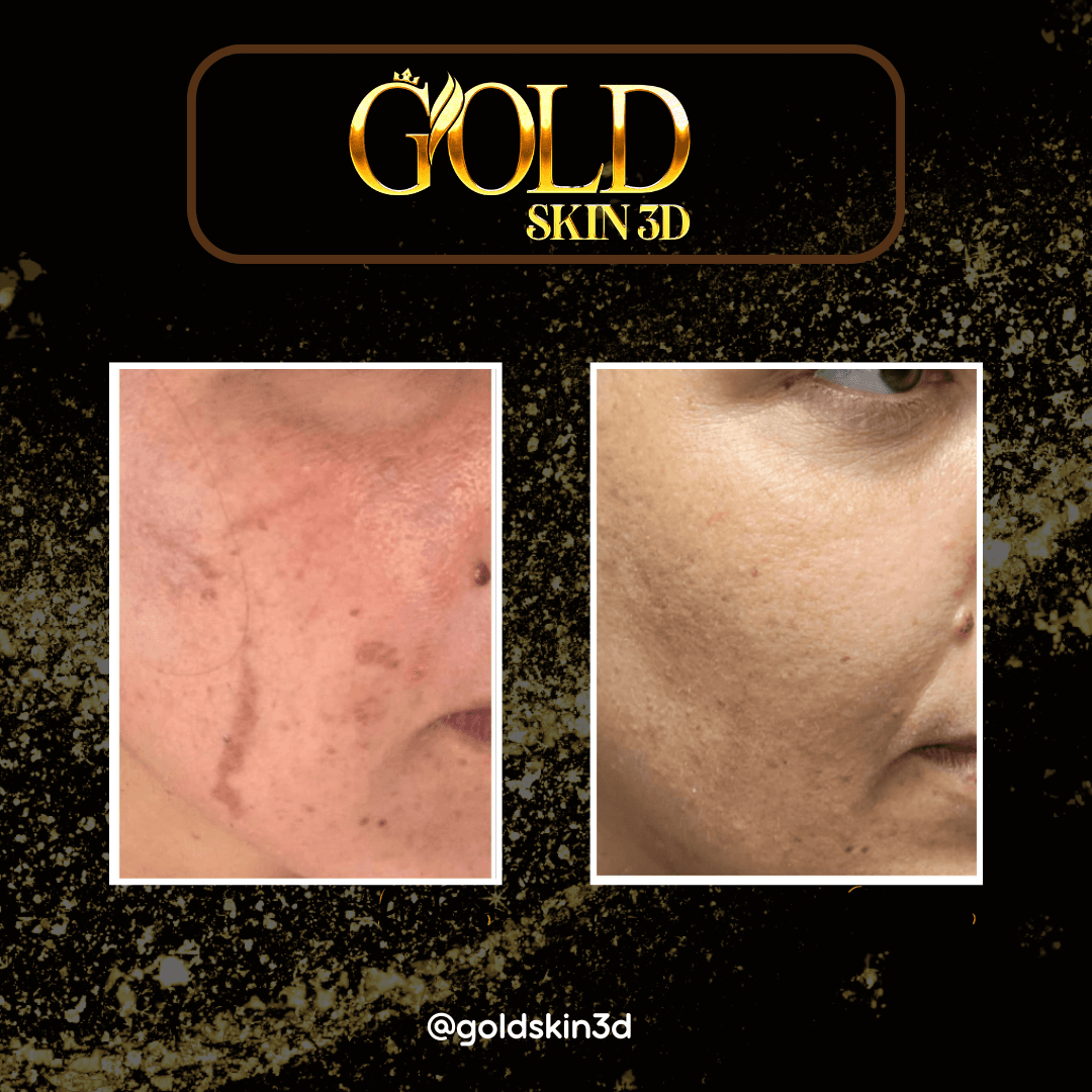 PROTOCOLO GOLD SKIN 3D