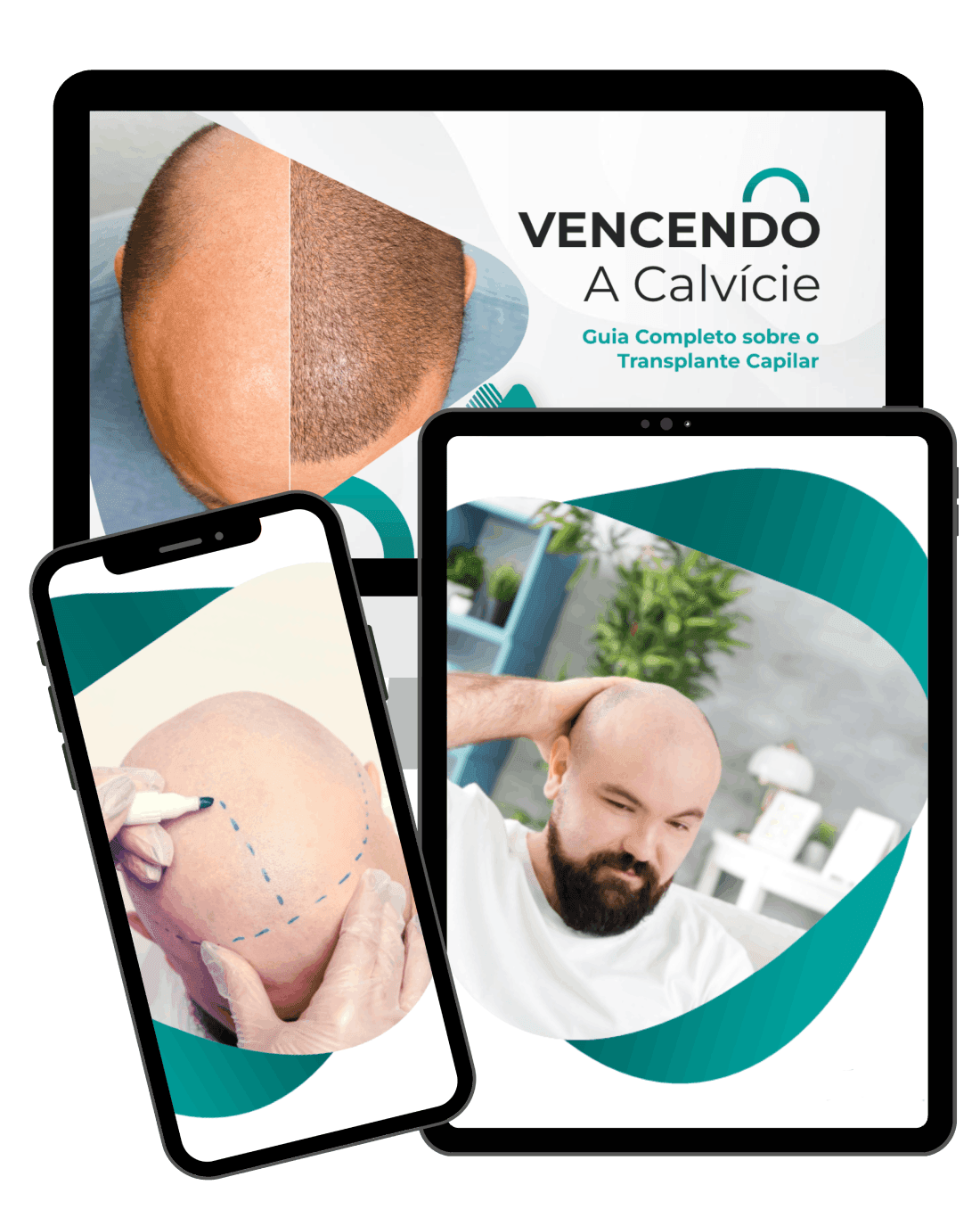 Vencendo a Calvície - Guia Completo para o Transplante Capilar
